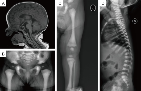 MiT family translocation renal cell carcinoma after malignant infantile osteopetrosis in childhood: a case report.